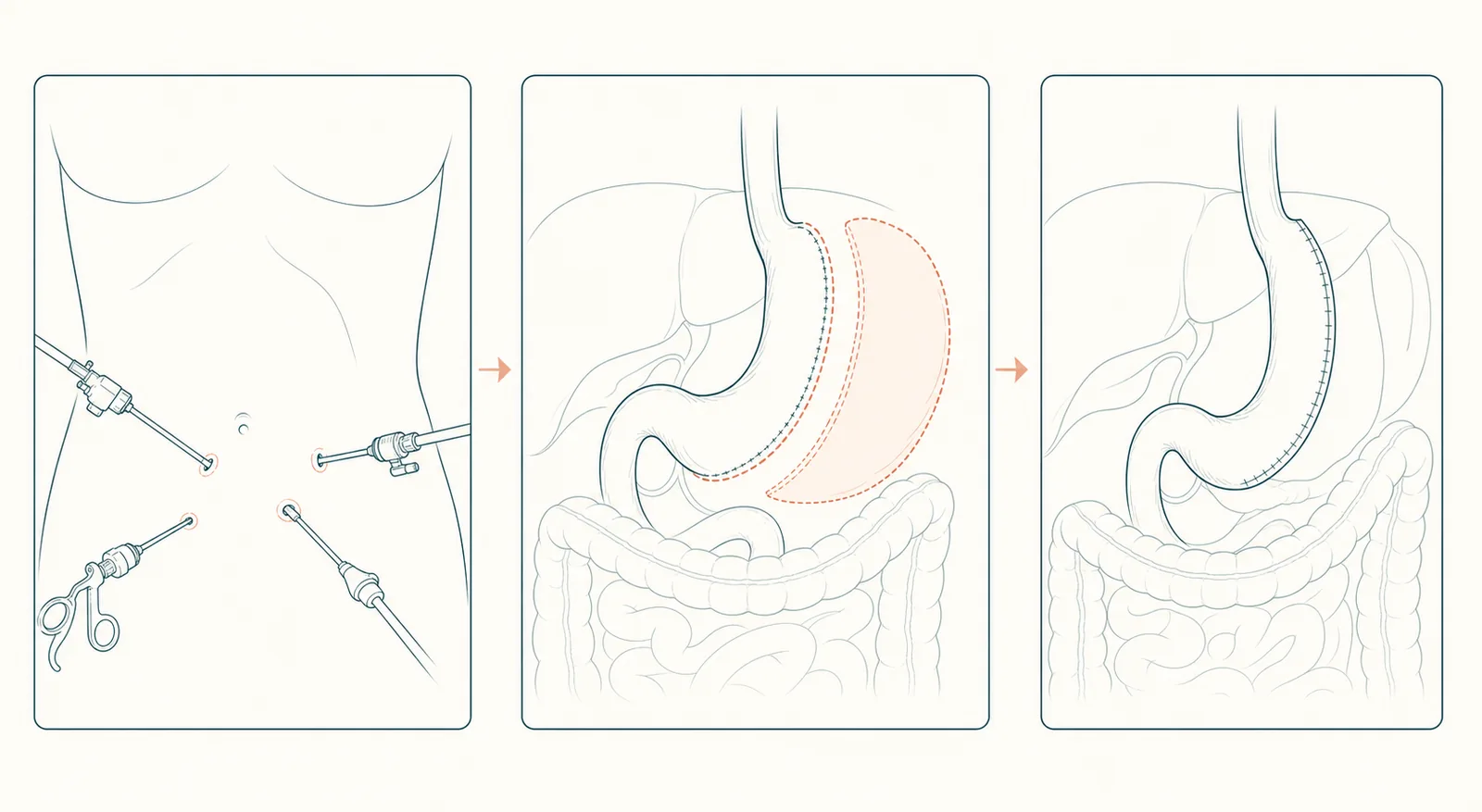 Three-panel line illustration: laparoscopic instruments through small incisions; roughly 75–80% of the stomach removed; the remaining narrow banana-shaped sleeve